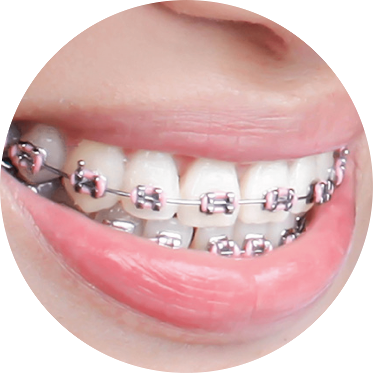 dental-braces-dentistry-orthodontics-human-tooth-orthodontics-surgery-29f70c63e158a26f37547642e3c75d82